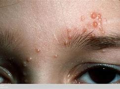 Image result for Molluscum Contagiosum Virus Morphology