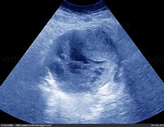 Image result for Large Ovarian Mass