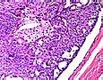 Image result for Ductal Papilloma