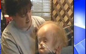 Image result for People Born without a Brain