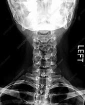 Image result for C-spine X-ray
