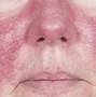Image result for What Does Rosacea Look Like
