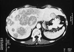 Image result for Gastrointestinal Carcinoid Tumor