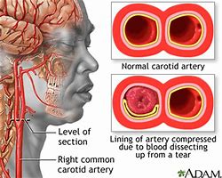 Image result for Carotid Arterial Dissection