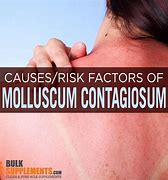 Image result for Molluscum Contagiosum Treatments for Adults