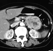 Image result for Pancreatic Masses Radiology
