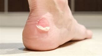 Image result for Blisters