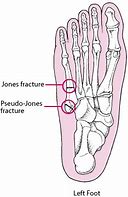 Image result for Pseudo-Jones Fracture