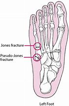 Image result for Jones Fracture vs Pseudo Jones Fracture