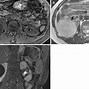 Image result for Renal Cyst MRI