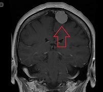 meningiomas 的图像结果