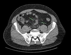 Image result for Bowel Perforation From Paracentesis
