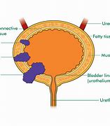 Image result for Ovarian Cancer Tumor Size