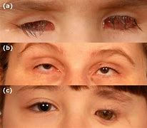 Image result for Anophthalmia