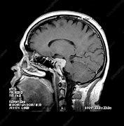 Image result for Skull Base Meningioma Brain Tumor
