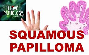Image result for Squamous Papilloma Treatment