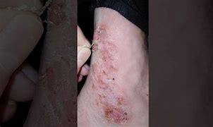 Image result for Eczema Scabs