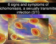 Image result for STI Trichomoniasis