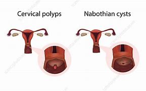 Image result for Cervix Cyst