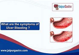 Image result for Bleeding Ulcer