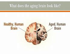 Image result for Shrinking of Brain in Late Aduldhood
