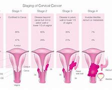 Image result for Stage 2 Cervical Cancer