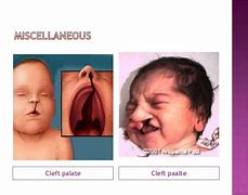 Image result for Congenital Anomaly Due to Folic Acid