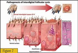 Image result for Home Cure Interdigital Cyst