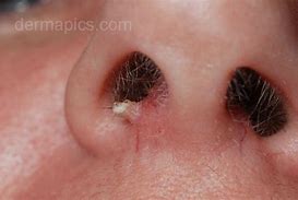 Image result for Wart On Rim of Nose