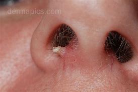 Image result for Wart in Nose