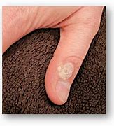 Image result for Common Warts Pictures