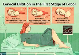 Image result for Dilated Labor