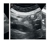 Image result for co_to_znaczy_zespół_po_cholecystektomii
