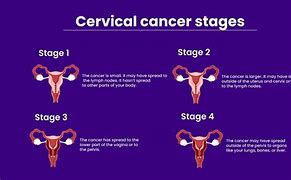 Image result for Adenocarcinoma Cervical Cancer