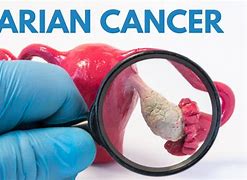 Image result for Ovarian Cancer