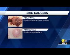 Image result for Stage 4 Squamous Cell Cancer