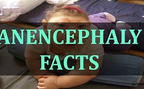 Image result for Anencephalous