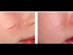 Image result for Dermabrasion Back Acne Scars