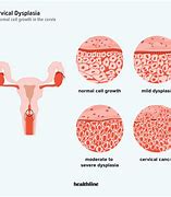 Image result for Abnormal Cervix Appearance