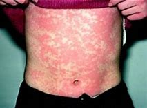 Image result for Allergic Rash On Face