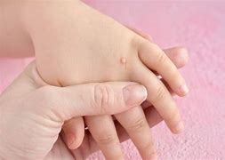 Image result for Pediatric Warts
