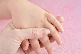 Image result for Wart On Child's Face