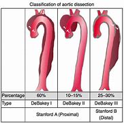 Image result for Aortic Dissection Types