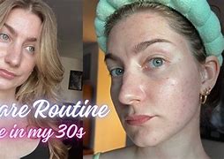 Image result for Different Kinds of Acne in Your 30s
