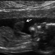 Image result for Ectopia Cordis Ultrasound