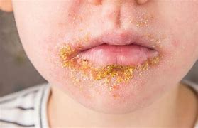 Image result for Impetigo Contagiosum