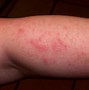Image result for Allergic Reaction to Cherries