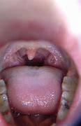 Image result for Growth On Uvula Papilloma