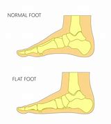 Image result for Flat Foot vs Normal Foot