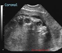 Image result for Anencephaly Ultrasound Front View